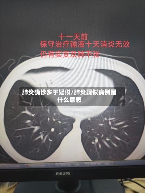 肺炎确诊多于疑似/肺炎疑似病例是什么意思