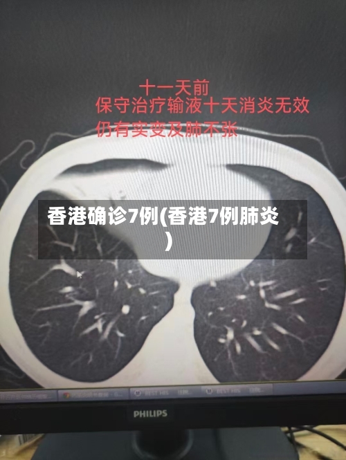 香港确诊7例(香港7例肺炎)