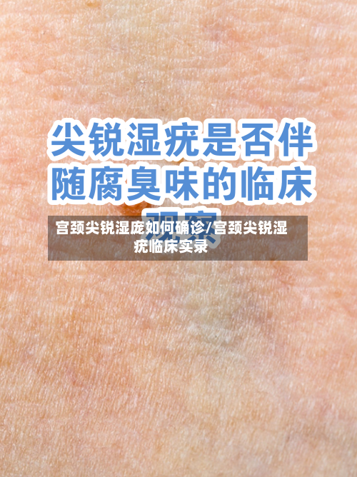 宫颈尖锐湿庞如何确诊/宫颈尖锐湿疣临床实录