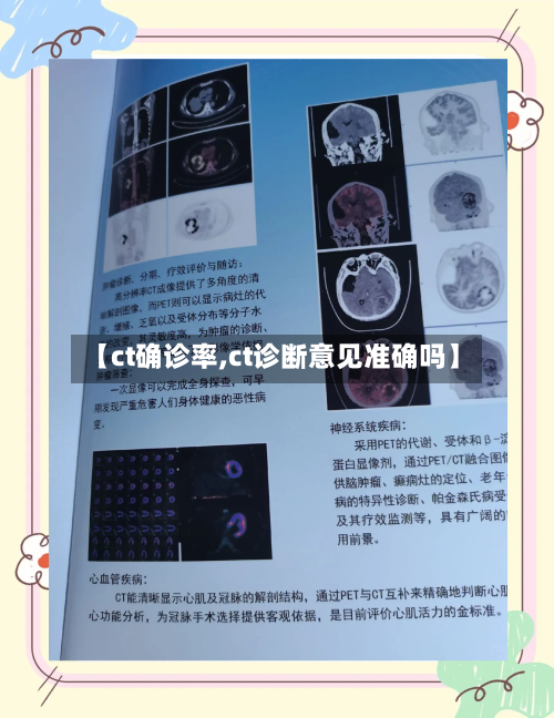 【ct确诊率,ct诊断意见准确吗】