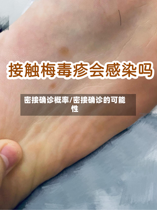 密接确诊概率/密接确诊的可能性