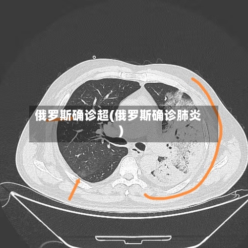 俄罗斯确诊超(俄罗斯确诊肺炎)