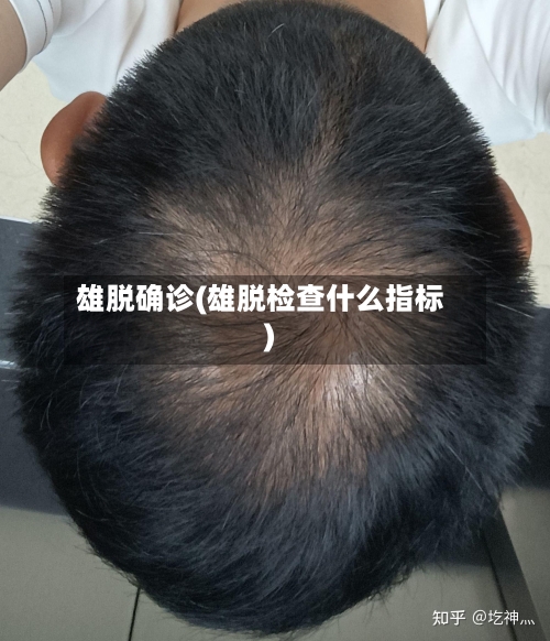 雄脱确诊(雄脱检查什么指标)