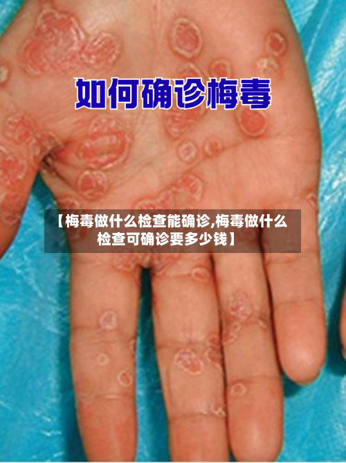 【梅毒做什么检查能确诊,梅毒做什么检查可确诊要多少钱】