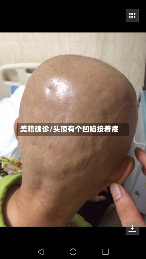 美籍确诊/头顶有个凹陷按着疼-第2张图片