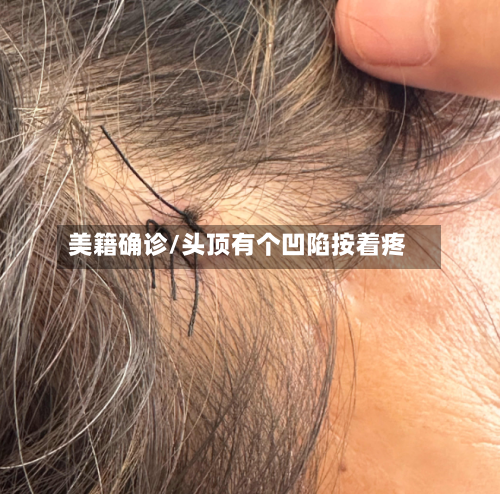 美籍确诊/头顶有个凹陷按着疼